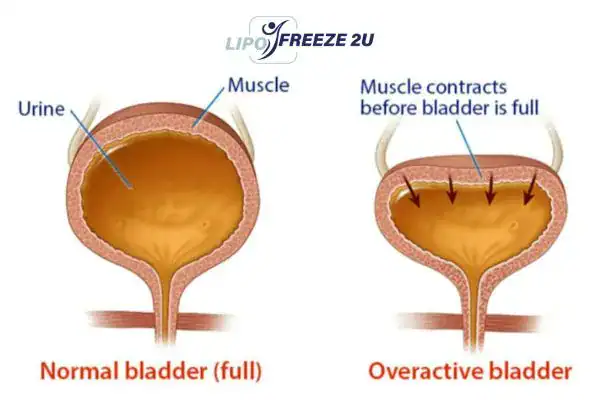 diagram of overactive bladder treatment Neasden