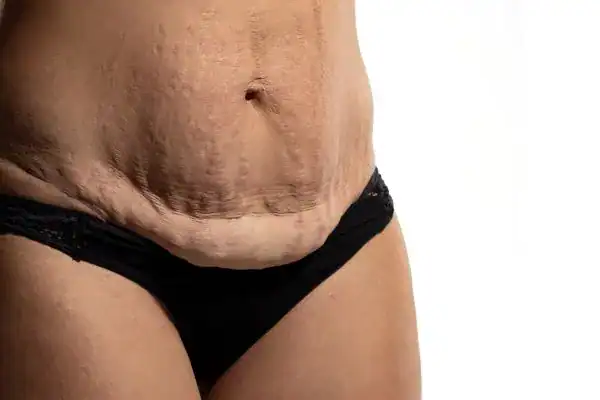 loose skin after weight loss injections Neasden