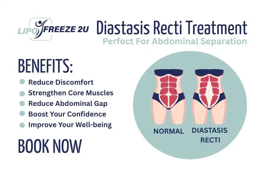How Long Will It Take to See Improvements in Diastasis Recti Neasden