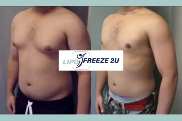 How Long Does It Take to See Results Neasden?