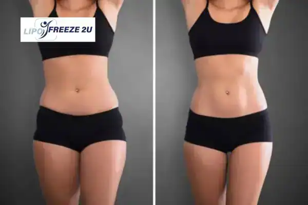 How Can LIPO FREEZE 2U Support Your Post-Pregnancy Body Recovery Neasden?