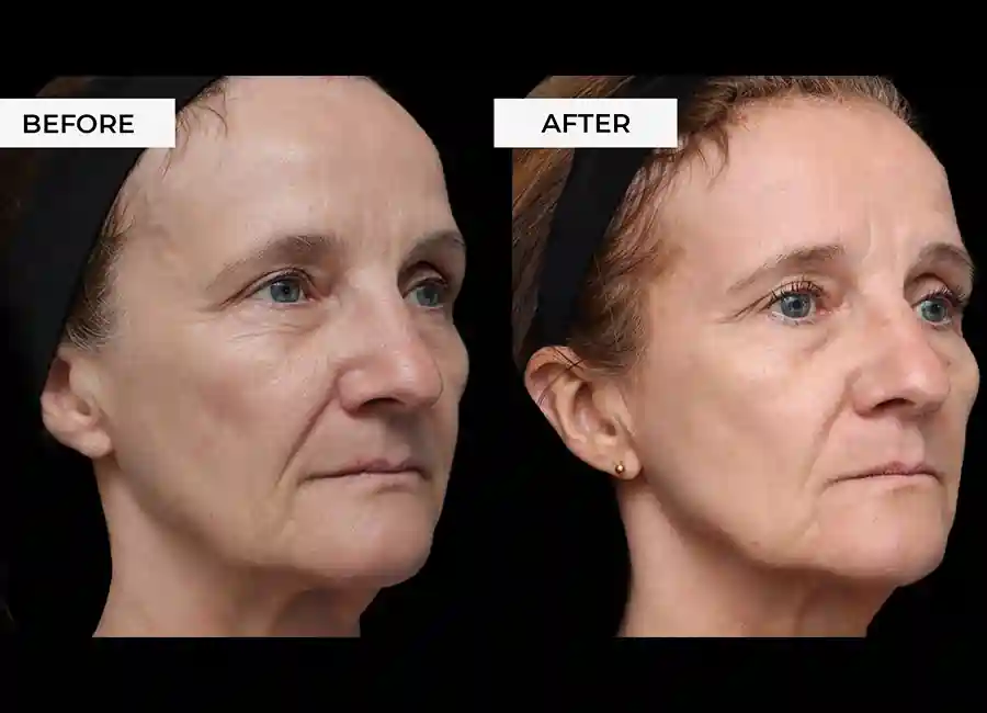 How Many RF Microneedling Sessions Will You Need to See a Difference Neasden?