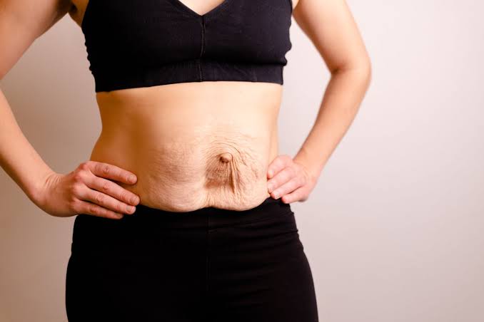 Is Surgery Really the Only Way to Repair Diastasis Recti Neasden?