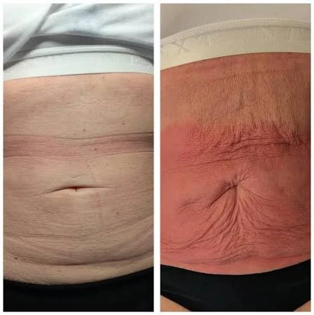 How Does RF Microneedling Improve Crepey, Thin and Uneven Skin Texture Neasden?