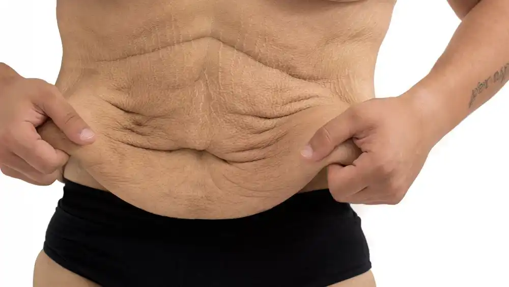 Why Does Weight Loss Medication Leave Some People With Loose or Sagging Skin Neasden?